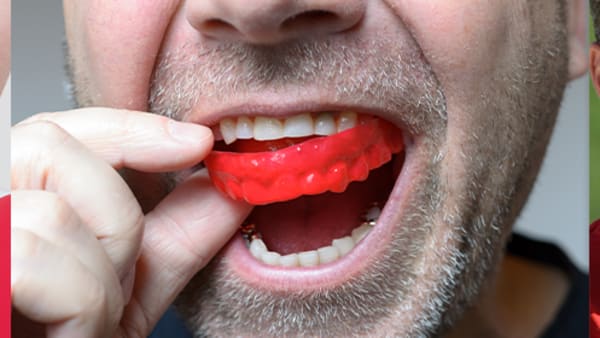 Keeping your mouth safe while playing sport