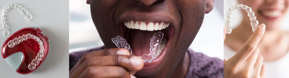 The dangers of DIY orthodontics